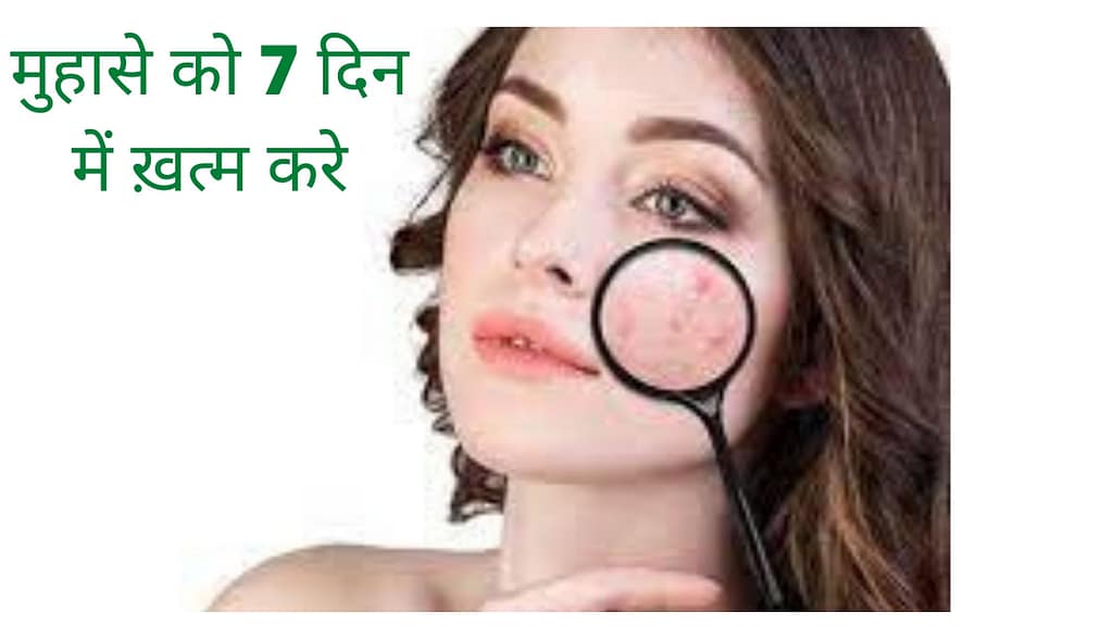 मुहासे को 7 दिन में ख़त्म करे जाने उसके घरेलू उपाय