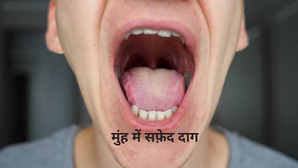 मुंह में सफ़ेद दाग (ल्यूकोप्लाकिया)