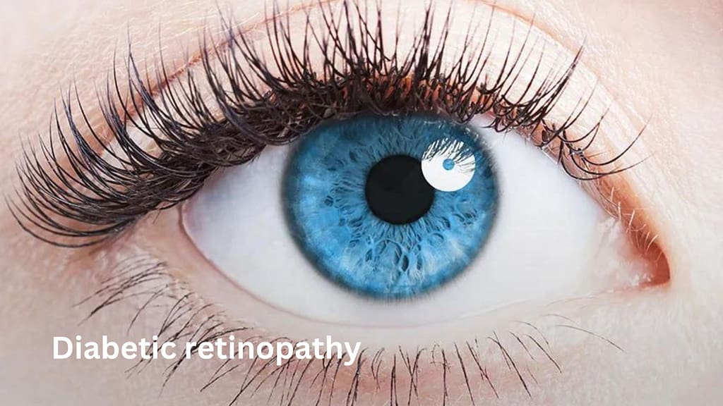 Diabetic retinopathy