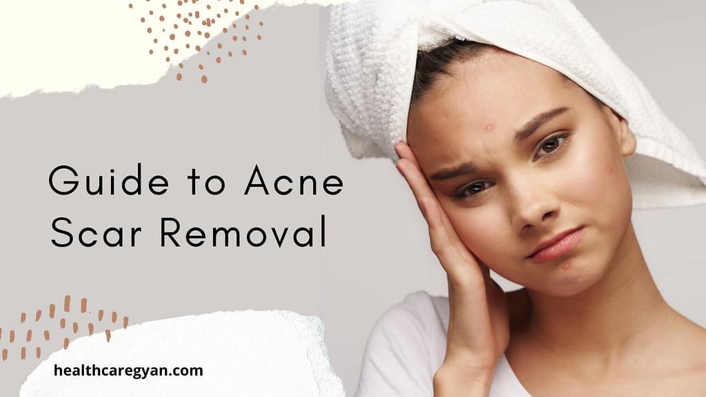 The Ultimate Guide to Acne Scar Removal Creams Perfect Remedies for Clear Skin