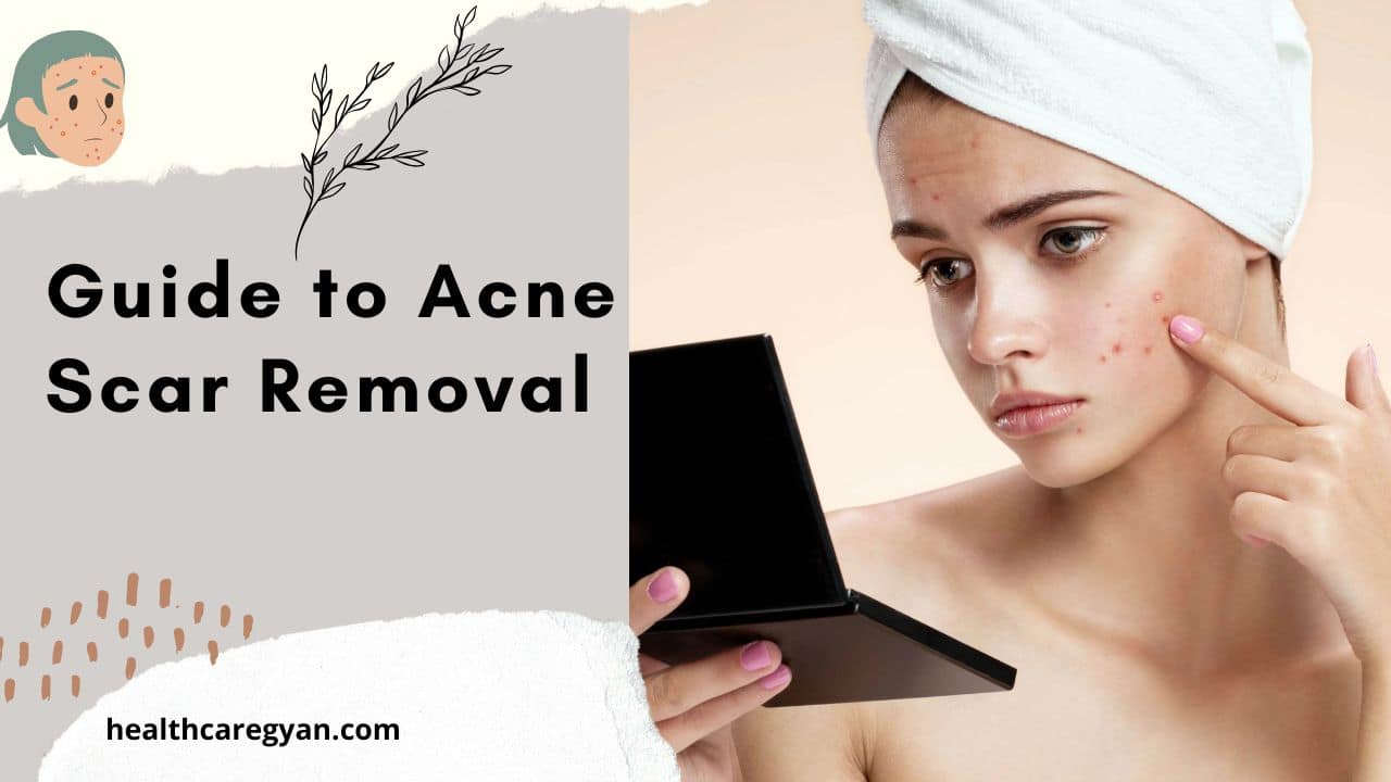 The Ultimate Guide to Acne Scar Removal Creams Perfect Remedies for Clear Skin