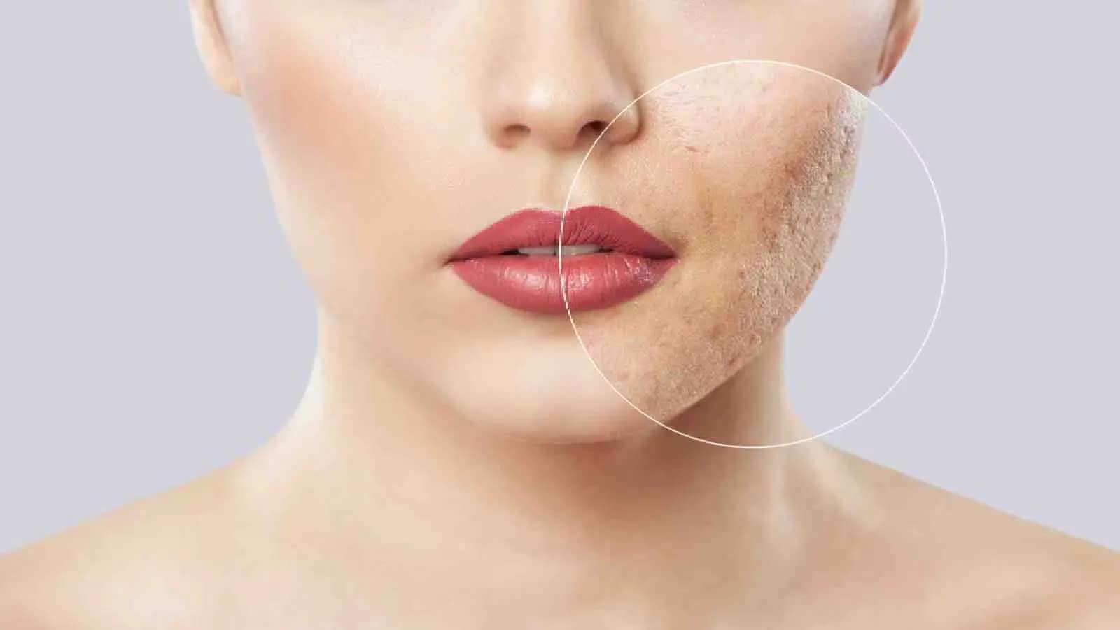How Can You Get Your Acne Scars to Go Away?