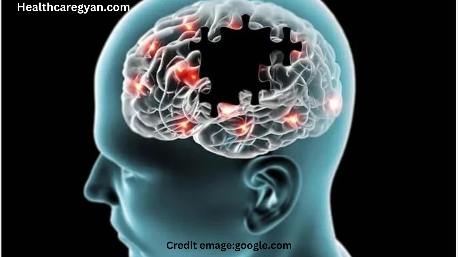 Alzheimer's disease In Hindi