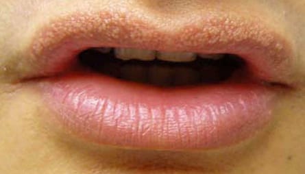 होठों के सफेद धब्बे कैसे हटाए इसके घरेलू उपाय