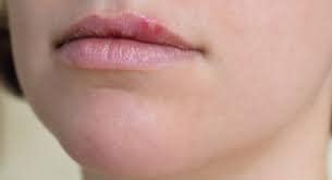 lips पर मुंहासे क्यों होते है उसके उपाय